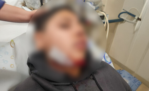 נער בן 14 הותקף בבית הספר ונדרש לניתוח ארוך